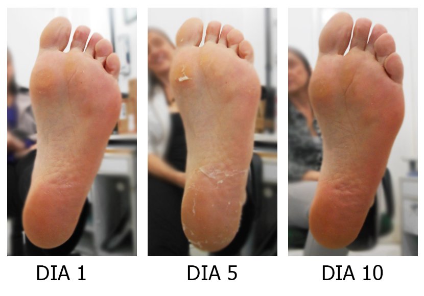 dermaweb-estetica-peeling-footner-meias